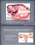 miscarriage rates with anticardiolipin